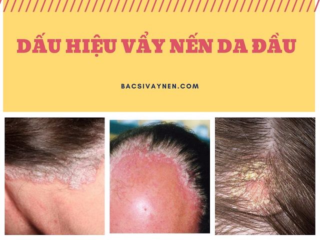Dấu hiệu bệnh vẩy nến da đầu