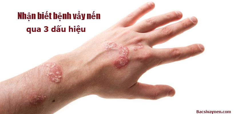 Dấu hiệu bệnh vẩy nến