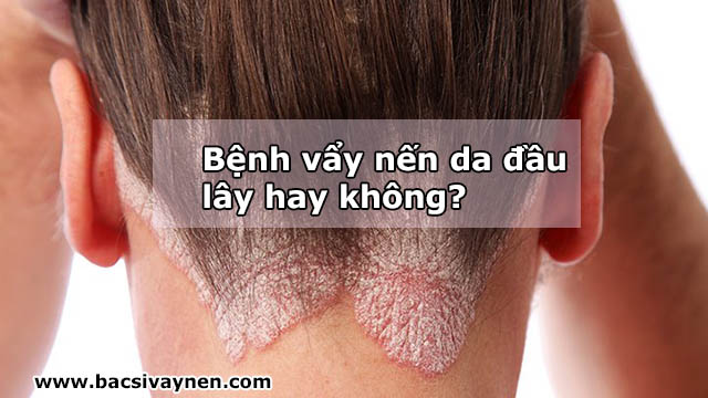 Bệnh vẩy nến da đầu 