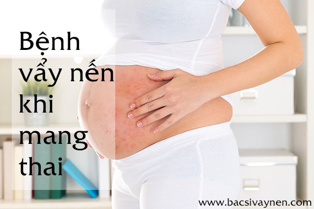 Bệnh vẩy nến khi mang thai