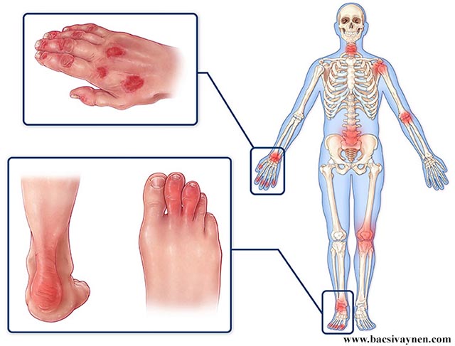 Viêm khớp vẩy nến