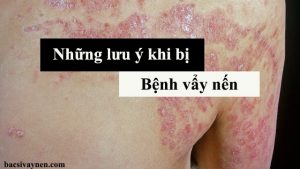 Bệnh vẩy nến có chữa khỏi được không