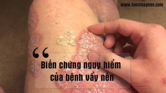 Biến chứng nguy hiểm của bệnh vẩy nến