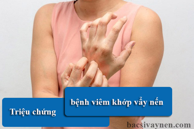 Triệu chứng bệnh viêm khớp vẩy nến