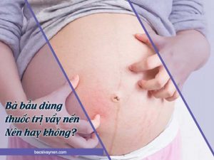 phụ nữ mang thai có nên uống thuốc trị vẩy nến không