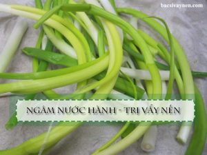 Cách chữa vẩy nến bằng hành hoa