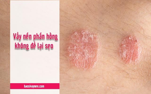 bệnh vẩy nến phấn hồng không để lại sẹo