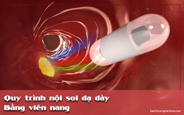 quy trình dùng viên nang để nội soi dạ dày